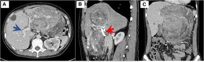 A rare case of giant hepatic angiomyolipoma with subcapsular rupture